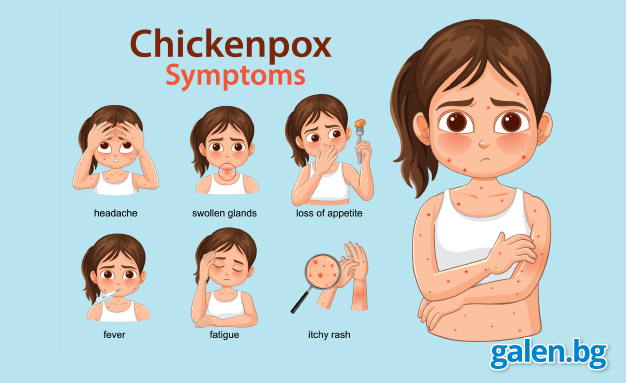 Варицела: първи симптоми, обрив и усложнения