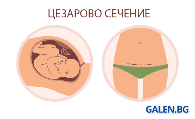 Цезарово сечение: как протича и как да се възстановим след него