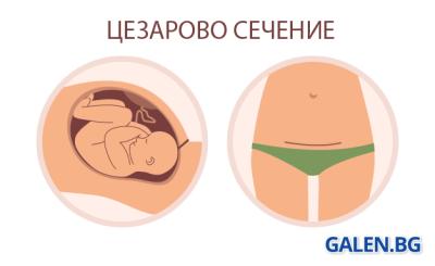 Цезарово сечение: как протича и как да се възстановим след него