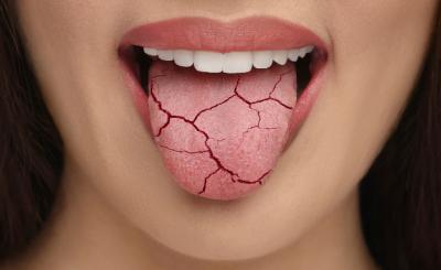 Какви са причините за сухота в устата?